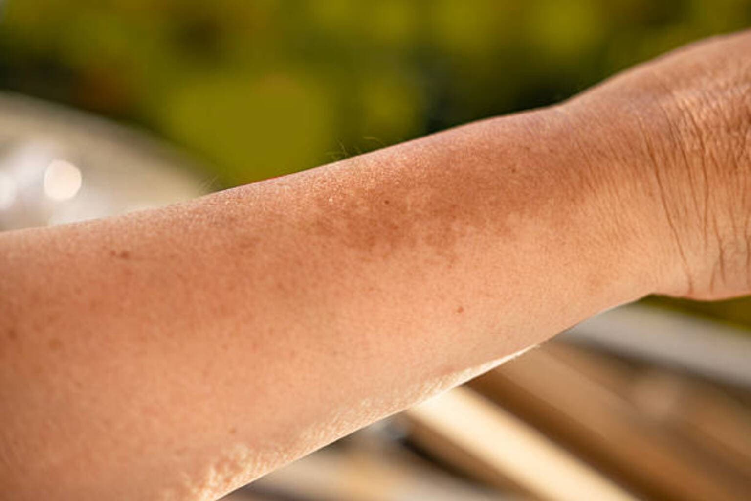 Disc Medicine plunges on FDA Complete Response Letter for bitopertin